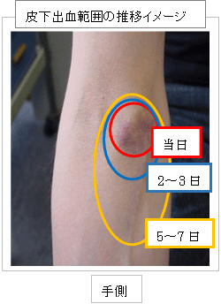 皮下出血イメージ